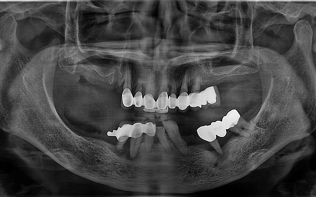 전악 케이스 Before 1