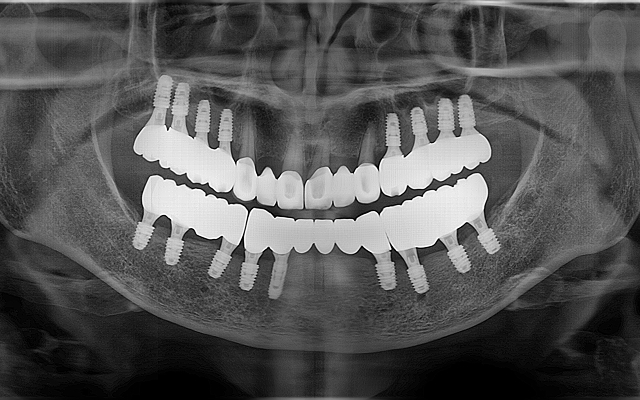 전악 케이스 After 1