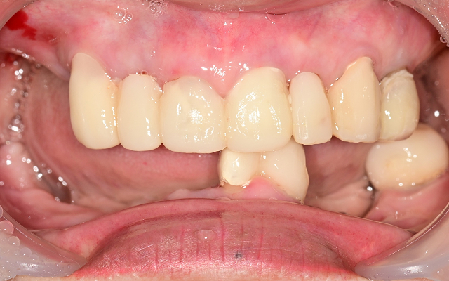 전악 케이스 Before 2