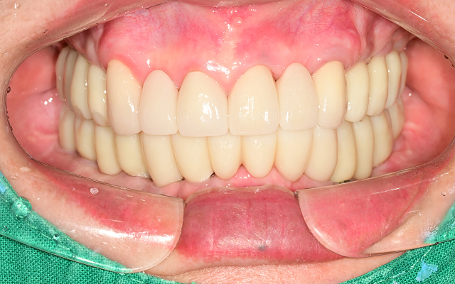 전악 케이스 After 2