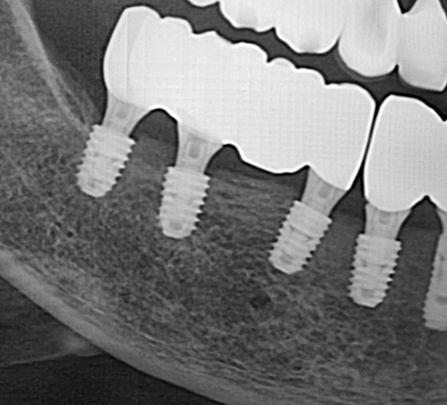 뼈이식 케이스 After 2