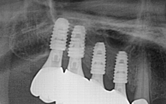 상악동 거상술 After 2