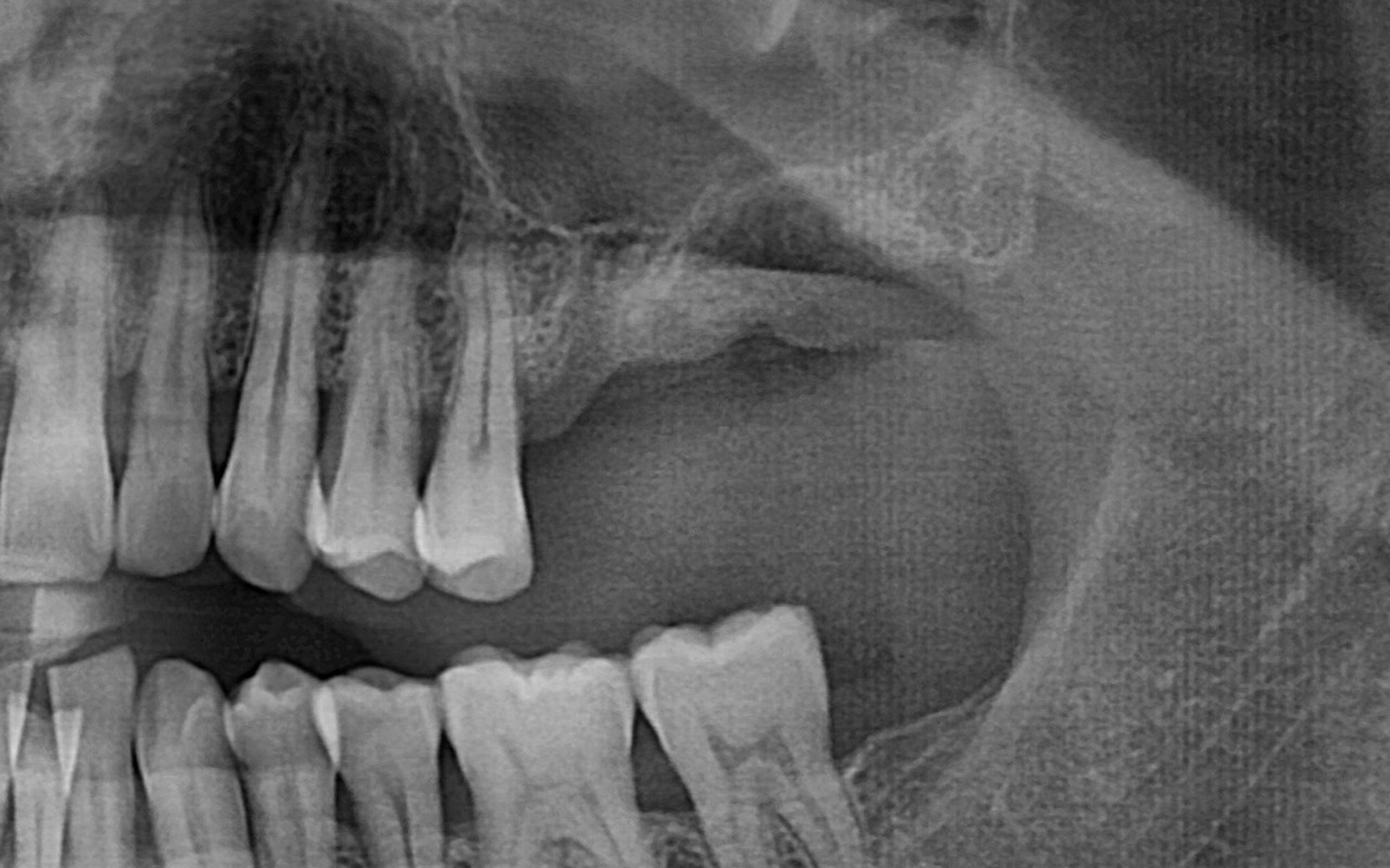 뼈이식·상악동 발치 후 · 치료 전 X-ray