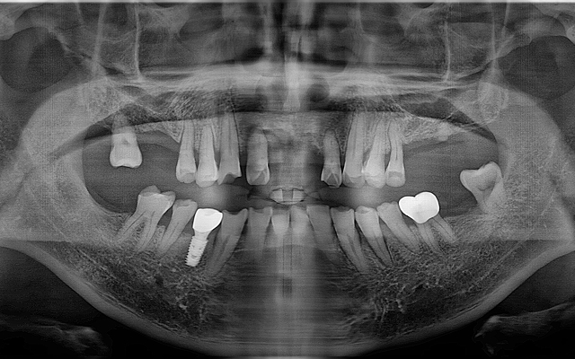 교합거상 케이스 Before 2