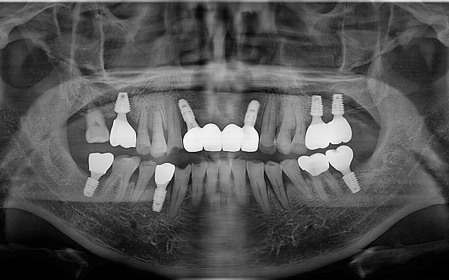 교합거상 케이스 After 2