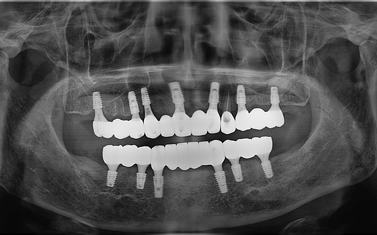 전악 임플란트 치료 후 파노라마 X-ray