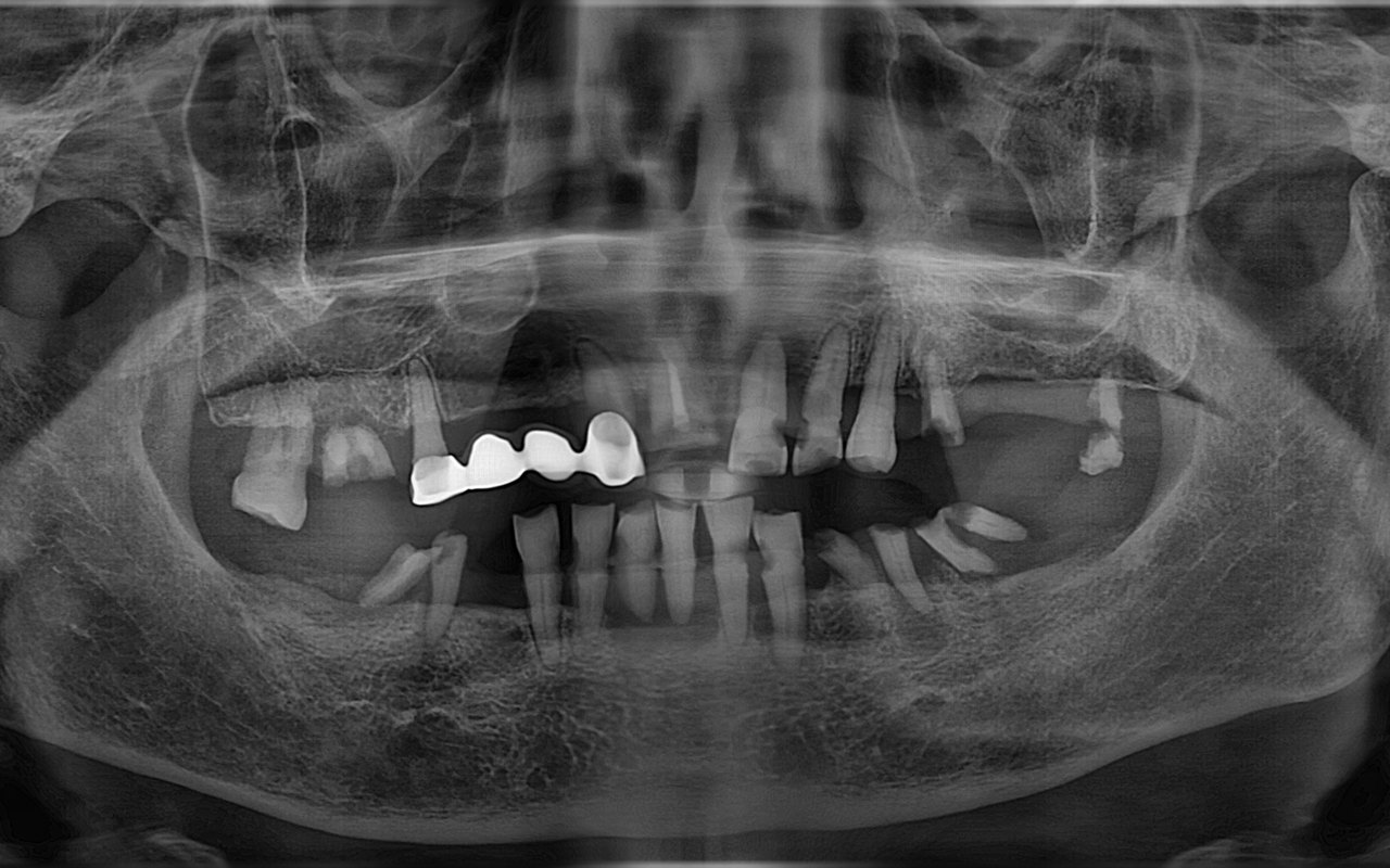 전악 임플란트 치료 전 파노라마 X-ray