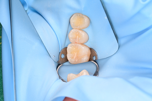 [BEFORE] 레진 빌드업 