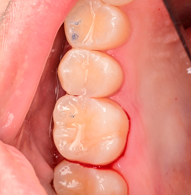 [AFTER]레진 빌드업 